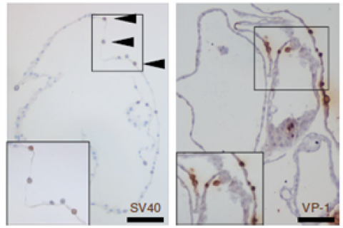 Figure 2. Tubuloids infected with BK virus adapt a phenotype characteristic of the disease.